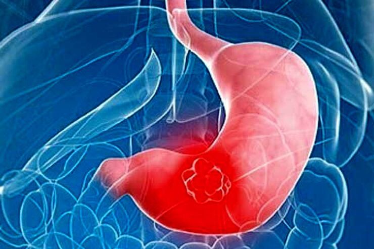 دو برابرشدن ابتلا به سرطان گوارش در جمعیت زیر ۵٠ سال کشور